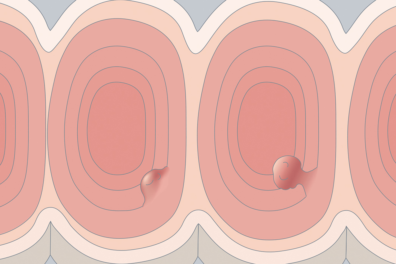 Clinical introduction to colorectal polyps