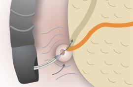 Endoscopic retrograde cholangiopancreatography (ERCP)