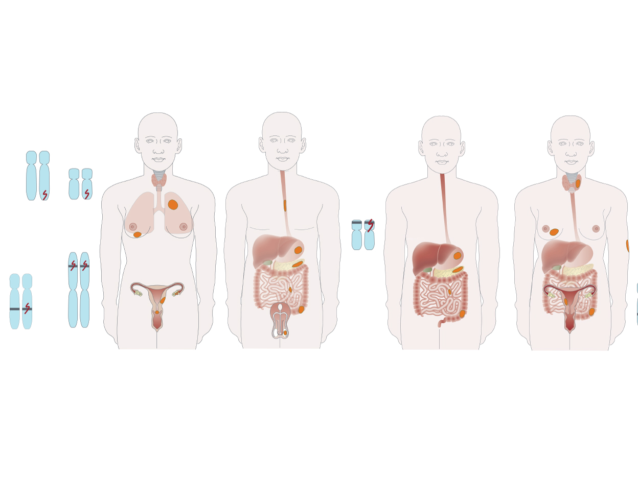 Hereditary gastrointestinal polyposis syndromes