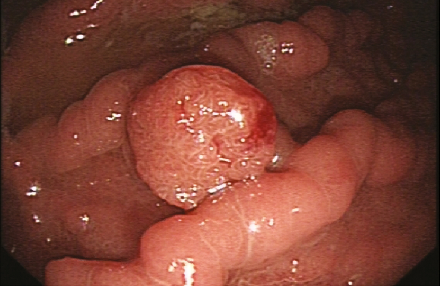 Gastrointestinal Neuroendocrine Tumours