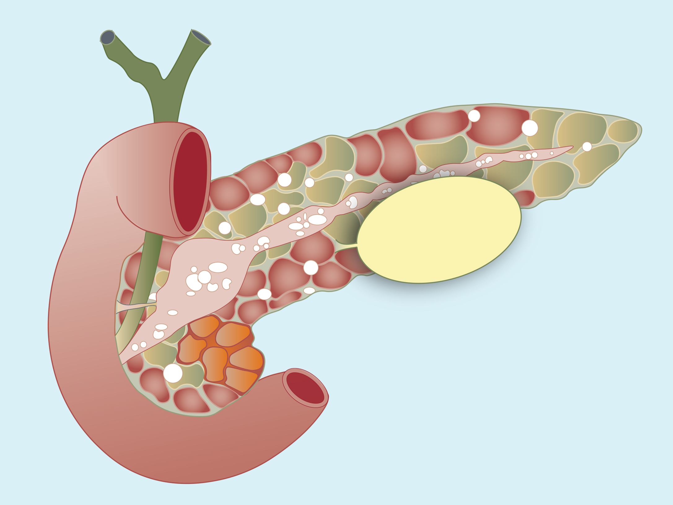 Chronic pancreatitis