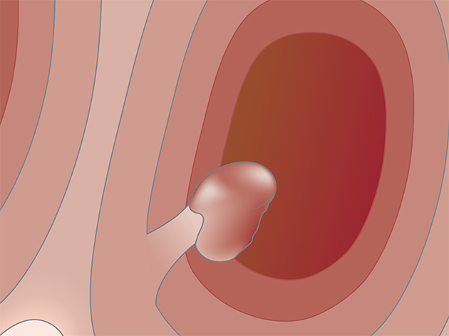 Polypectomy