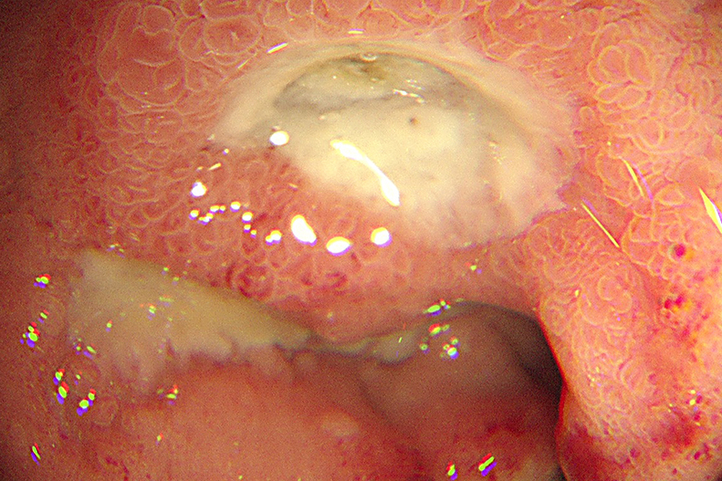 Emergency upper gastrointestinal bleeding