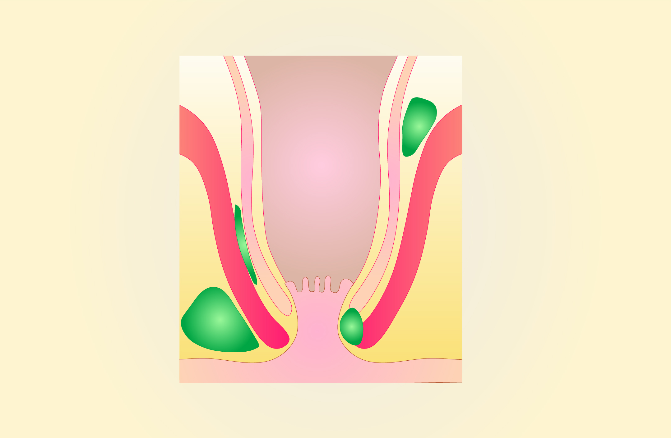 Proctology — anatomy, anal fissure and anal abscess and fistula