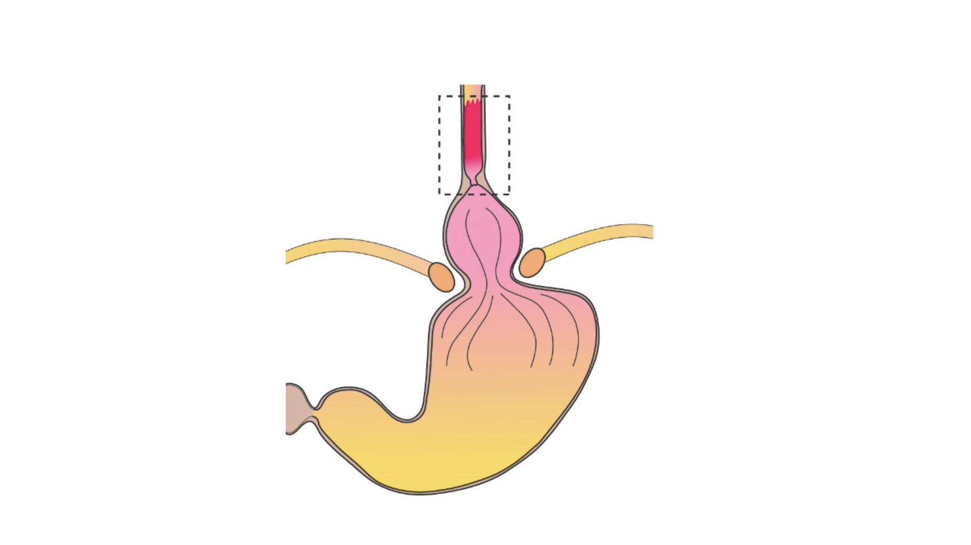 Barrett Oesophagus - pathophysiology, diagnosis, surveillance and treatment