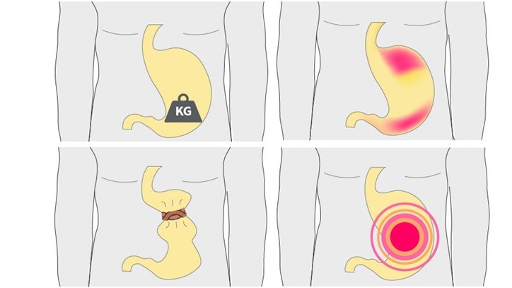 Functional dyspepsia: Diagnosis and treatment