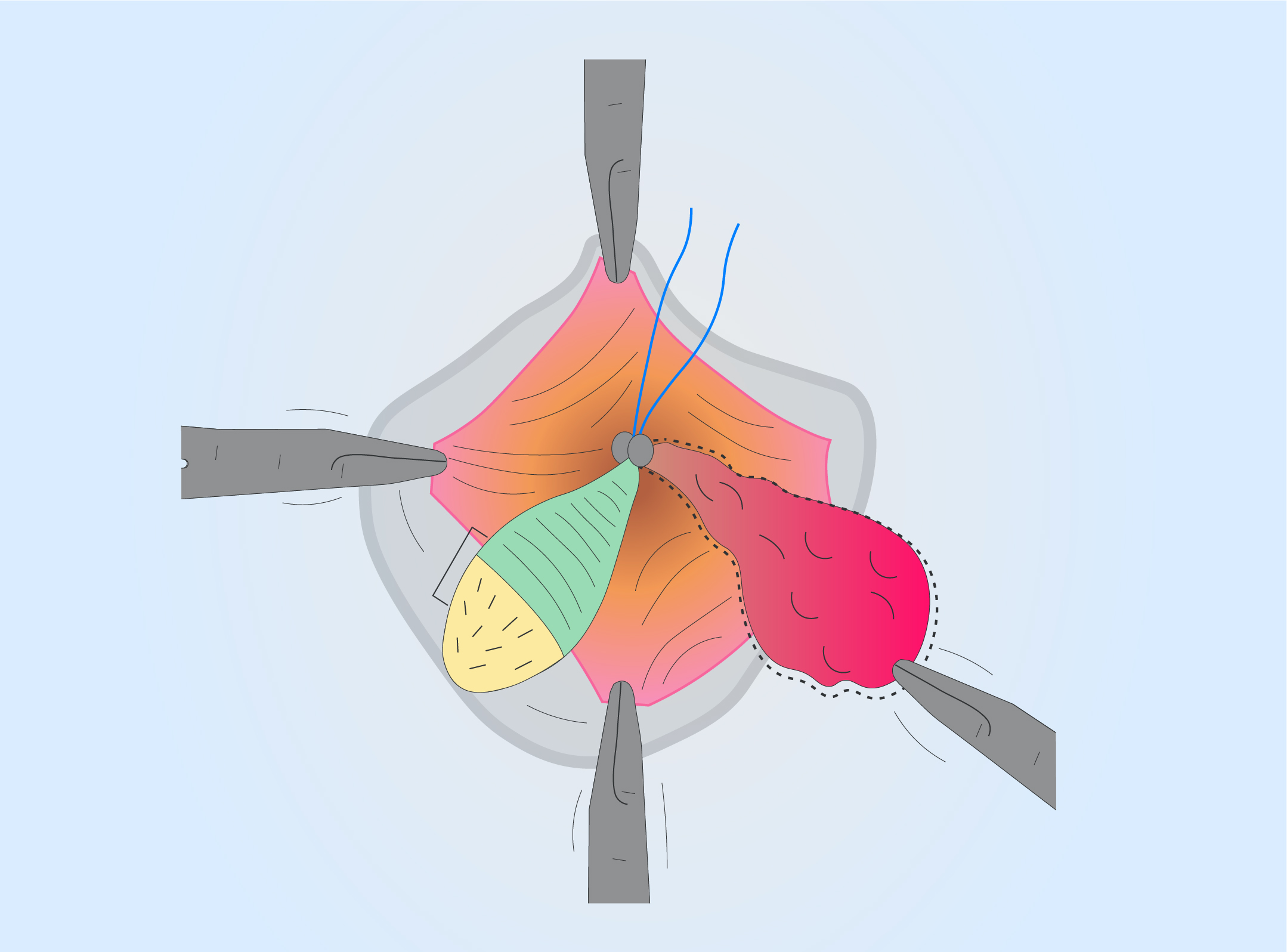 Proctology — haemorrhoids and perianal skin conditions