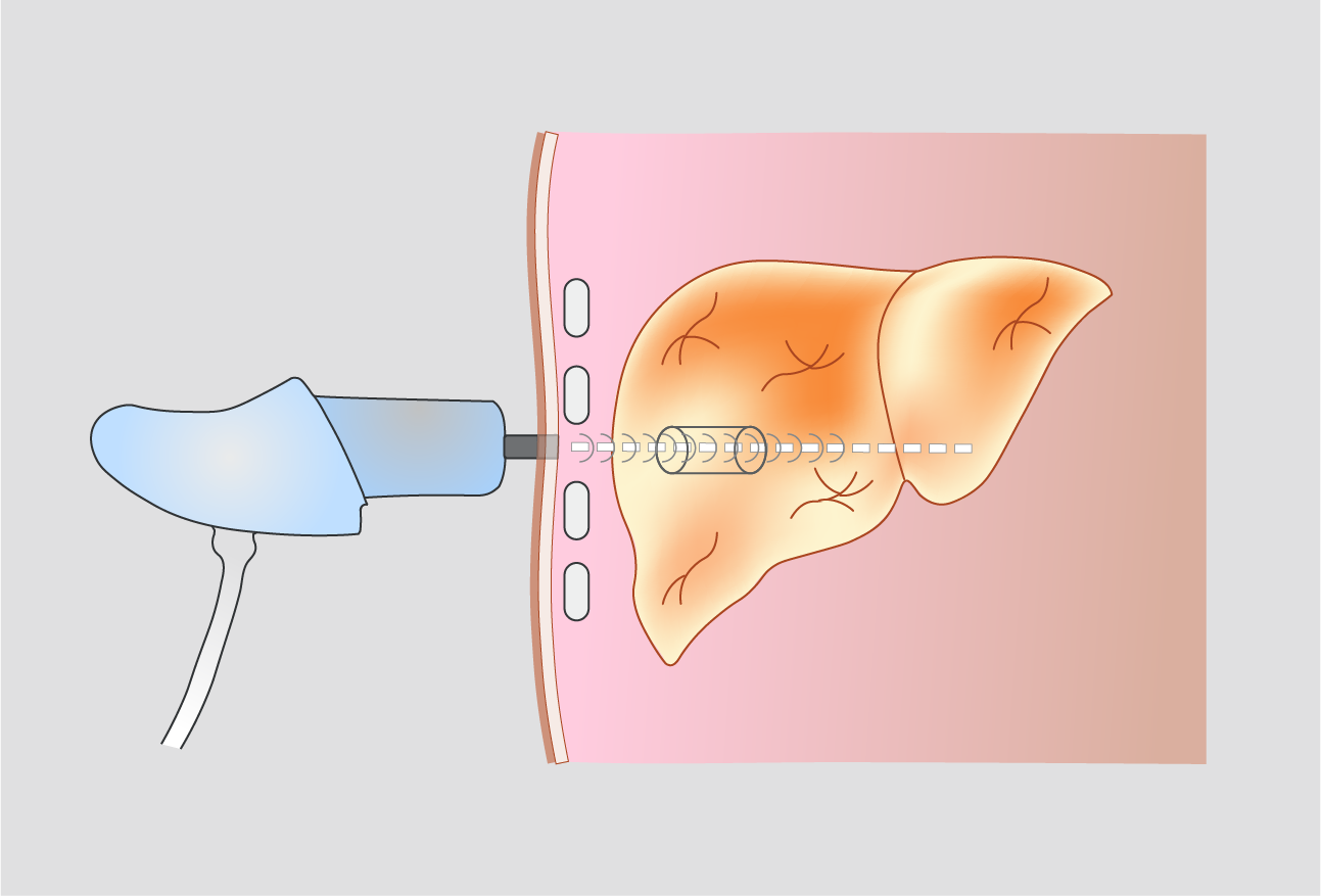 Metabolic Dysfunction-Associated Steatotic Liver Disease