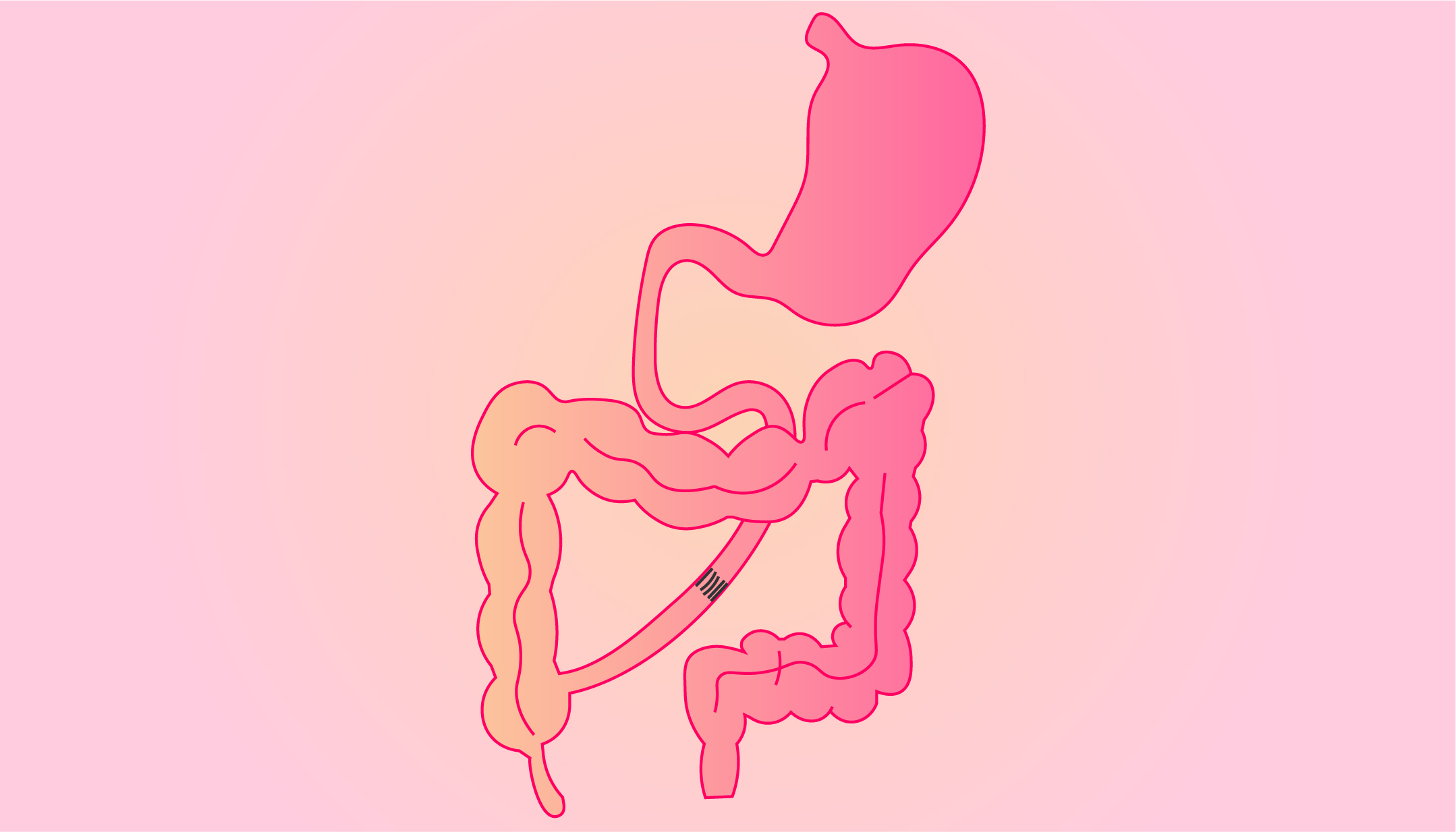 Intestinal failure and parenteral nutrition