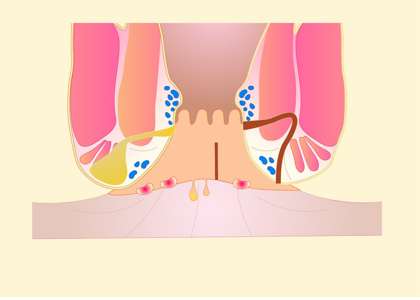 Perianal Crohn's disease