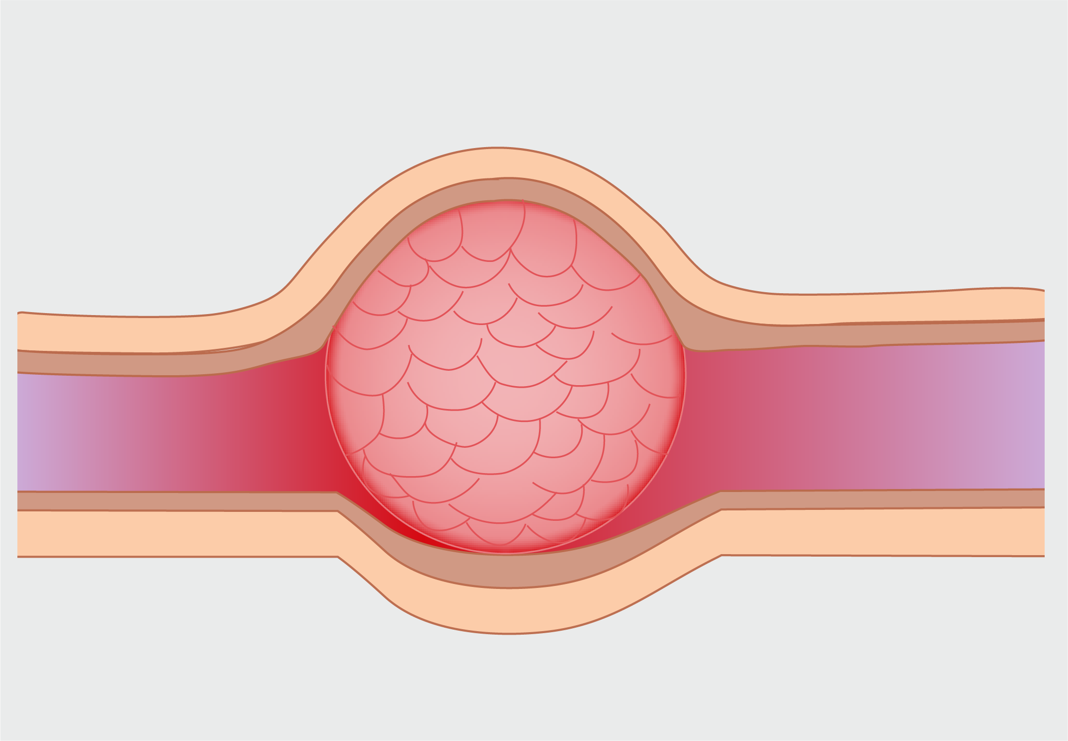 Subepithelial Lesions in the Upper Gastrointestinal Tract